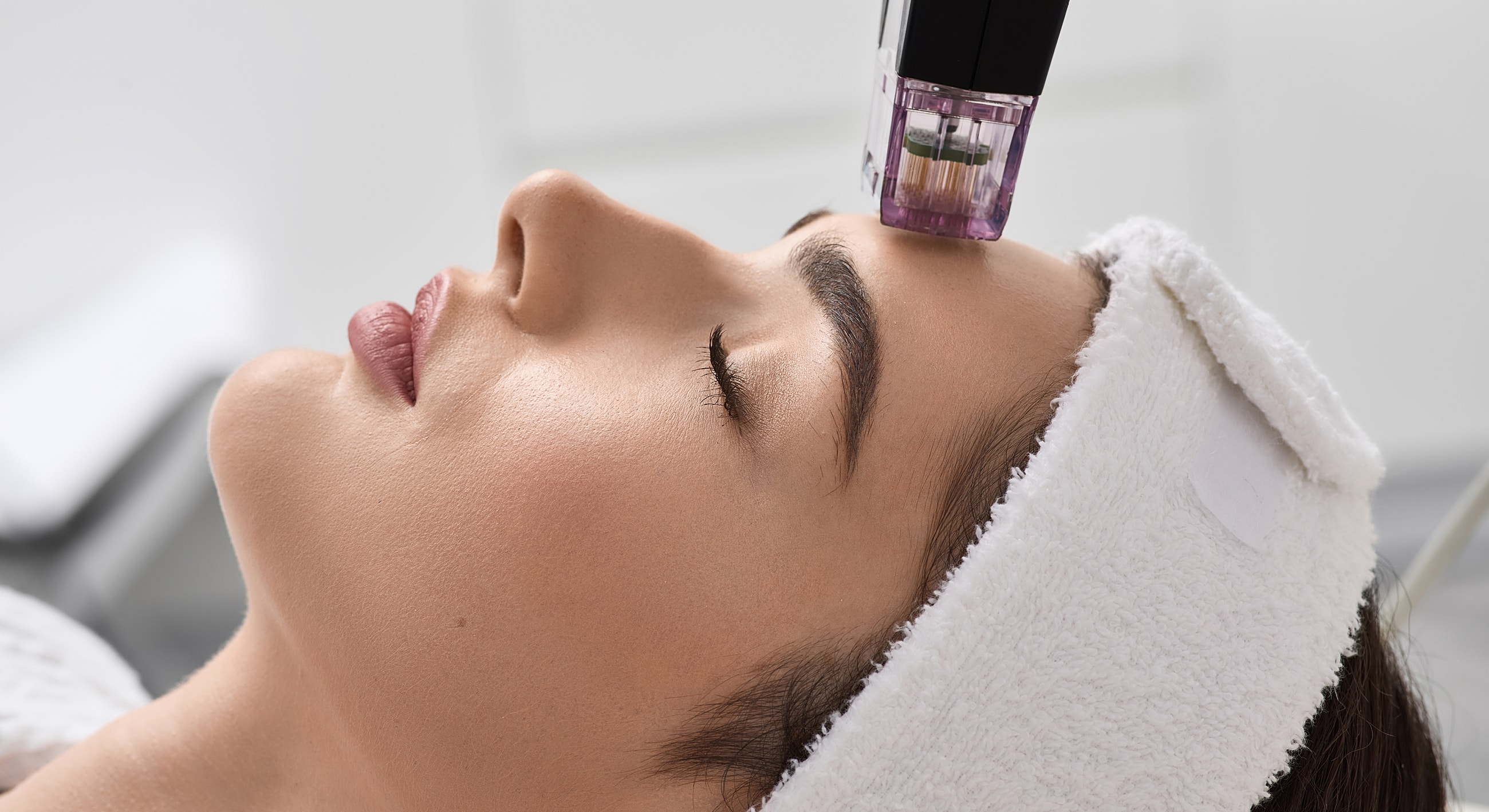 Facial treatment using a microneedling device.
